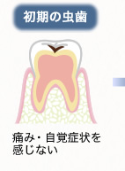 初期の虫歯：痛み・自覚症状を感じない