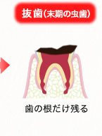 抜歯（末期の虫歯）：歯の根だけ残る
