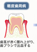 軽度歯周病：歯茎が赤く腫れ上がり、歯ブラシで出血する