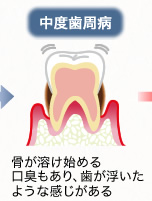 中度歯周病：骨が溶け始める口臭もあり、歯が浮いたような感じがある