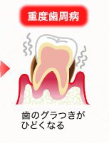 重度歯周病：歯のグラつきがひどくなる