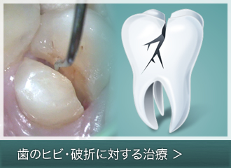 歯のヒビ・破折に対する治療